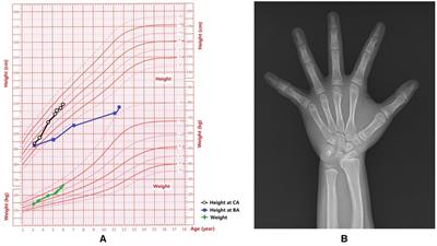 Gonadal Y-chromosome mosaicism with 45, X Turner syndrome complicated with bilateral HCG-secreting gonadoblastoma